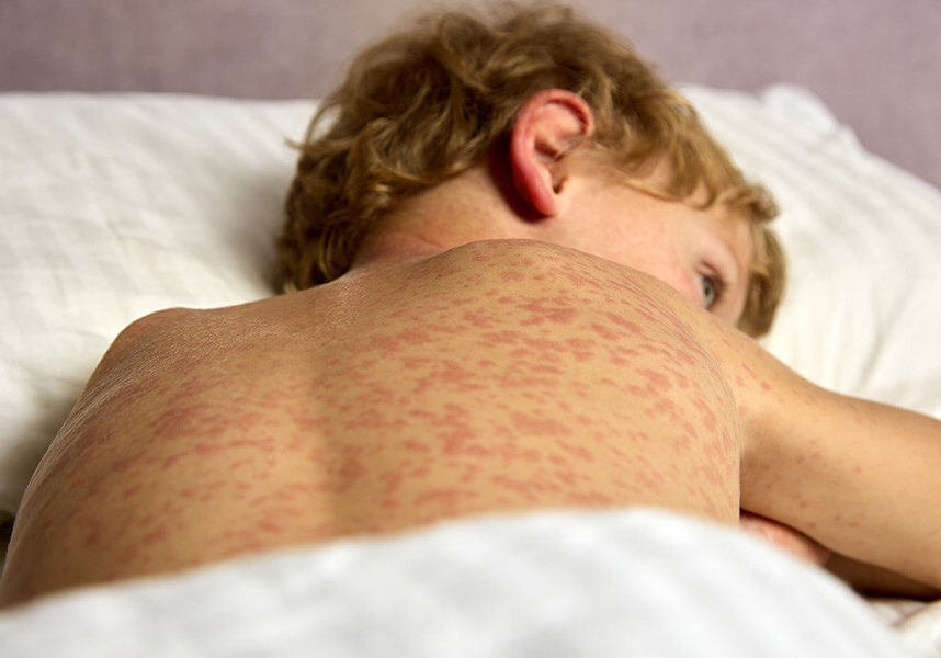 Measles is a highly contagious disease and can have serious health effects.